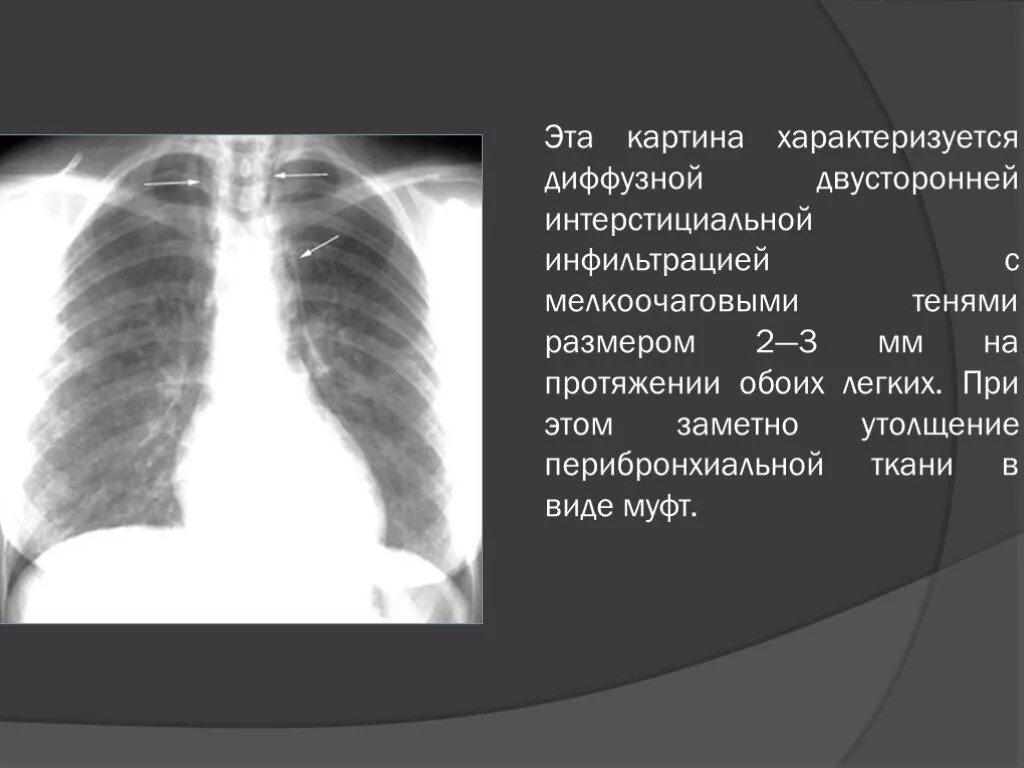 Периинциальная инфильтрация. Перибронхиальная инфильтрация. Перибронхиальная инфильтрация легких что это такое. Перибронхиальная инфильтрация рентген. Двухсторонняя диффузная