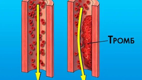 Тромб в сердце оторвался. Оторванный сердечный тромб. Сердечный тромбоз