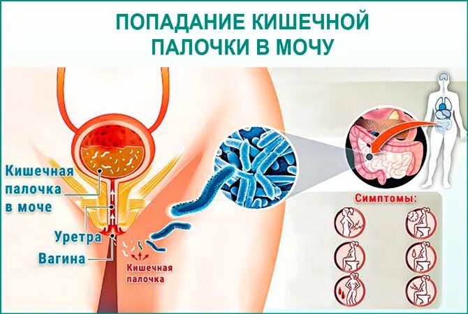 Треугольник льето мочевого пузыря. Лечение палочки в мочевом пузыре. Туберкулез мочевого пузыря симптомы. Инфекция мочевыводящей системы у детей. Кишечная палочка в мочевом пузыре у женщин.