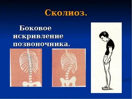 Боковое искривление