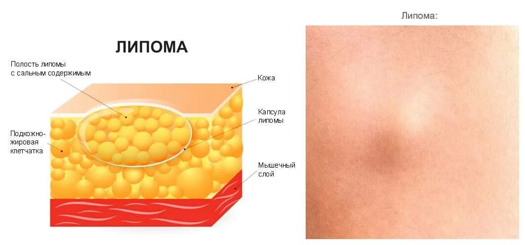 Капсула жировика. Подкожно-жировая клетчатка липома. Липома доброкачественная опухоль жировой ткани. Липома жировой ткани кожи. Липома подкожной жировой клетчатки.