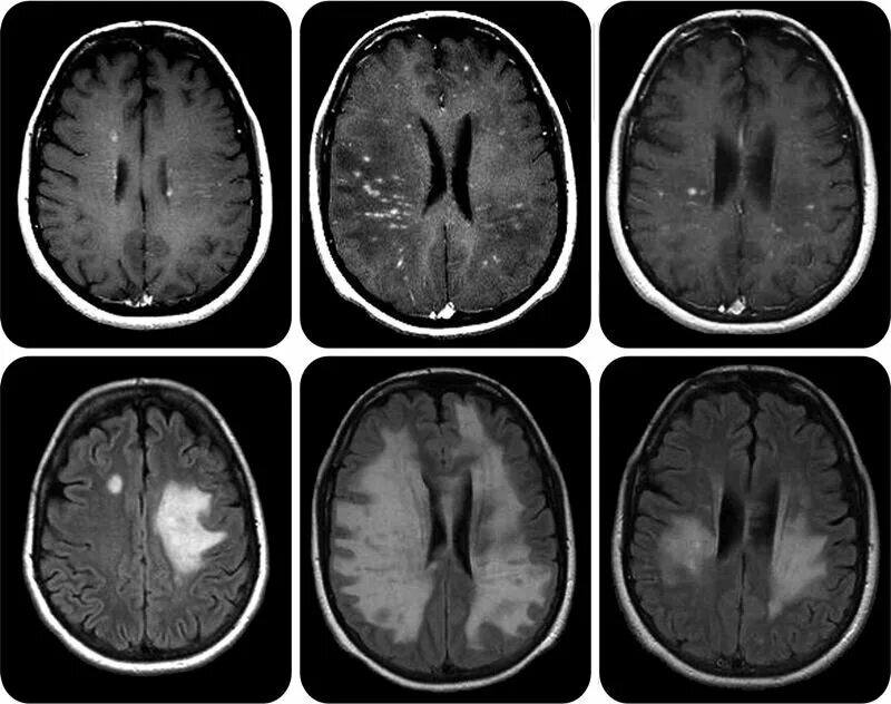 Склероз мозга. Рассеянный склероз на мрт головного мозга. Демиелинизация головного мозга мрт. Очаги рассеянного склероза на мрт. Очаги демиелинизации головного мозга на мрт при рассеянном склерозе.