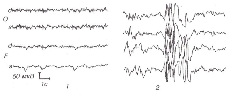 Генерализованная Спайк волна на ЭЭГ. Генерализованные разряды на ЭЭГ. Генерализованные Спайк волновые разряды на ЭЭГ. Вспышка Спайк медленная волна на ЭЭГ. Спайк на ээг