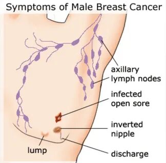 Signs and symptoms of breast cancer in men.