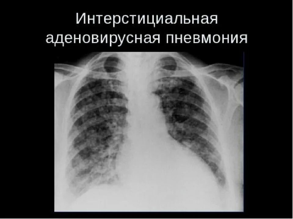 Изменение в легких у ребенка. Рентген при внебольничной пневмонии. интерстициальные заболевания легких рентген. пневмония долевая интерстициальная. рентген легких снимок с пневмонией.