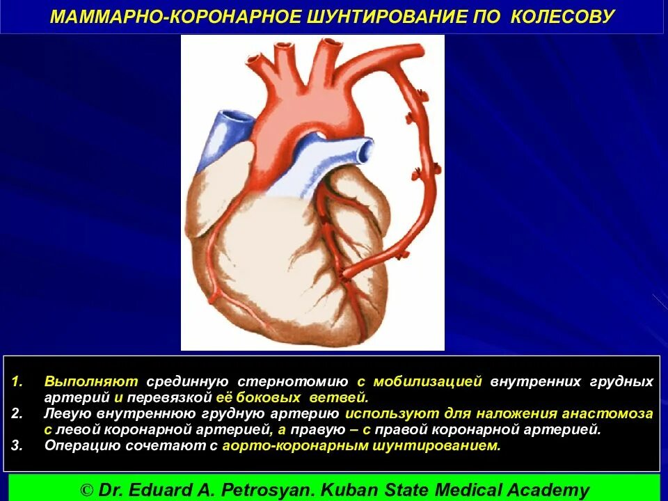 Операция Колесова маммарно коронарное шунтирование. Аортокоронарное шунтирование техника. Маммарокоронарное шунтирование техника. Аортокоронарное шунтирование ЭФЛЕР. Что такое шунтирование сердца и сосудов