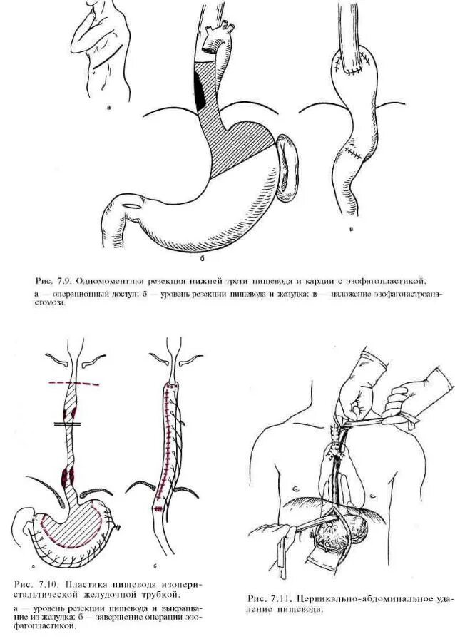Операции на пищеводе. Эзофагопластика пищевода схема операции. Экстирпация пищевода с пластикой желудочной трубкой. Пластика пищевода желудочным стеблем. Пластика пищевода антиперистальтической желудочной трубкой.