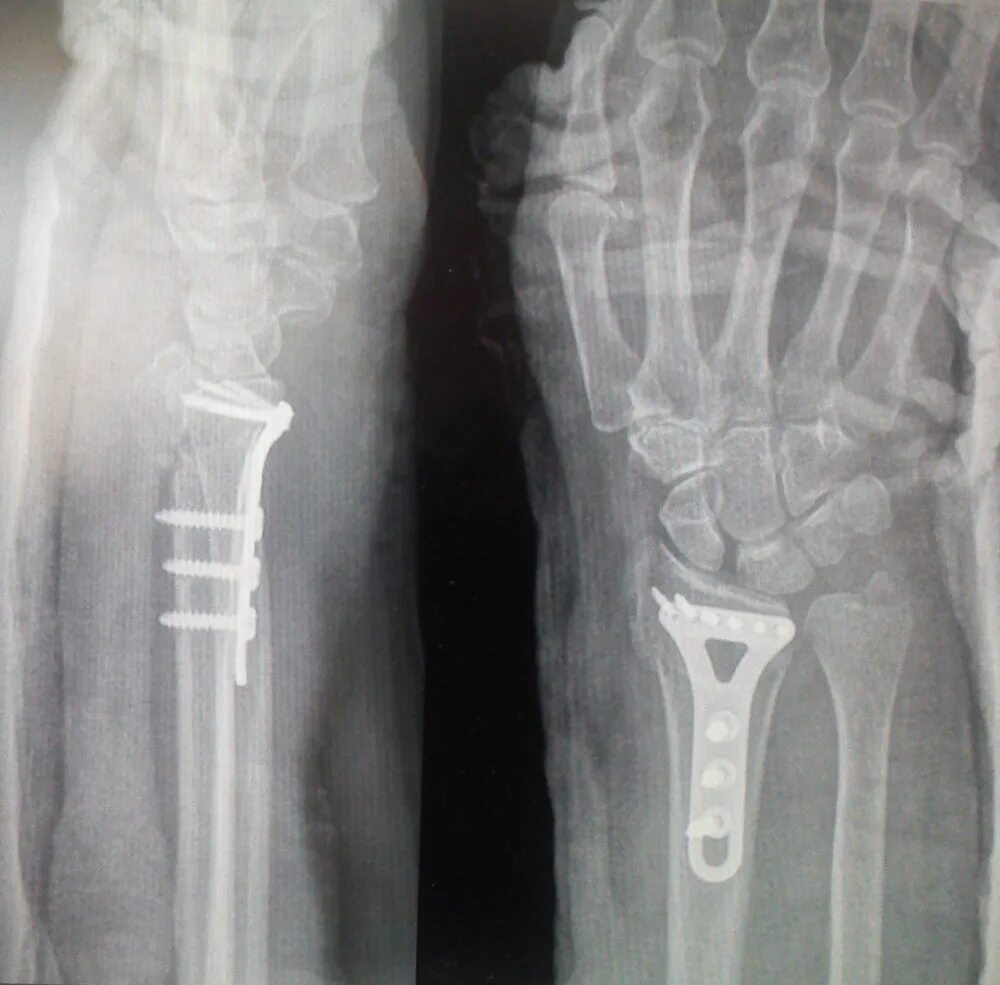 Перелом со смещением нужна операция. Остеосинтез лучевой кости пластиной. Остеосинтез перелома лучевой кости. Остеосинтез дистального метаэпифиза лучевой кости. Остеосинтез перелома лучевой кости пластиной.