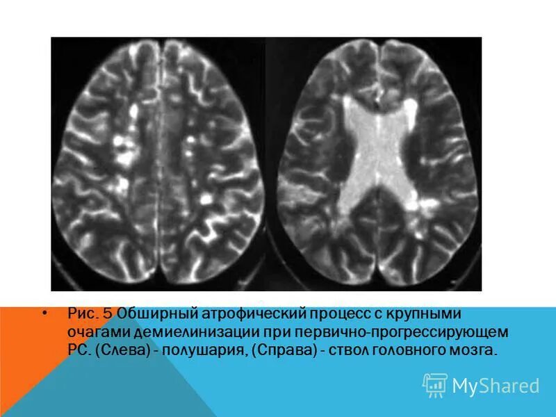 Первично-прогрессирующий рассеянный склероз. Демиелинизирующие очаги. Демиелинизирующие заболевания головного мозга. Демиелинизирующие очаги головного мозга.