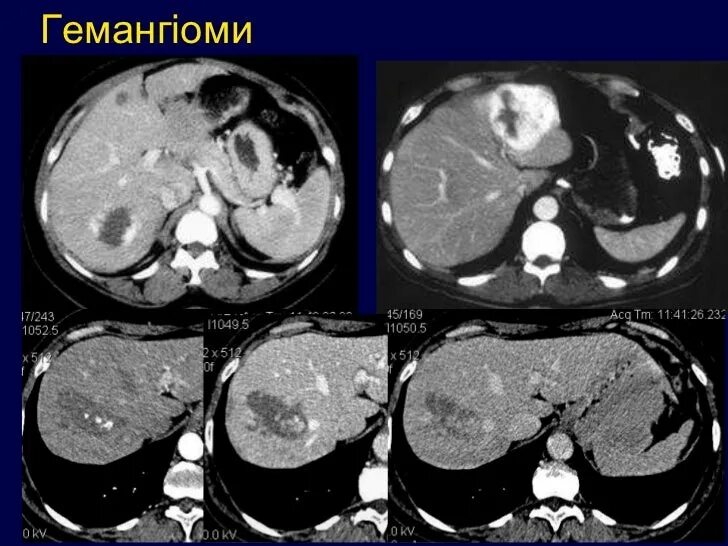 Гамартома печени. Мезенхимальная гамартома печени. Билиарная гамартома кт. Билиарная гамартома печени кт.