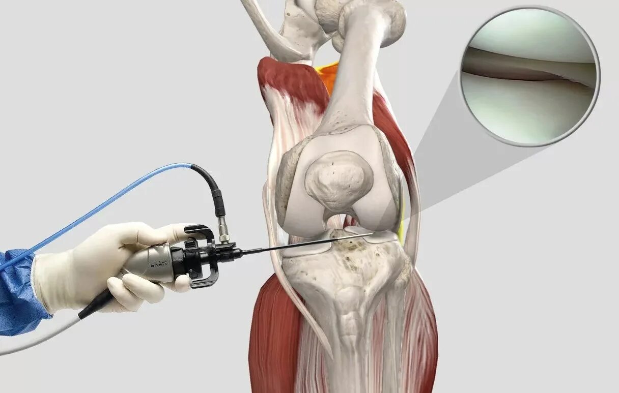 Разрыв мениска артроскопия. Артроскопическая пластика ПКС. Артроскопия мениска коленного сустава операция. Артроскопическая менискэктомия коленного сустава. Передняя крестообразная связка после операции