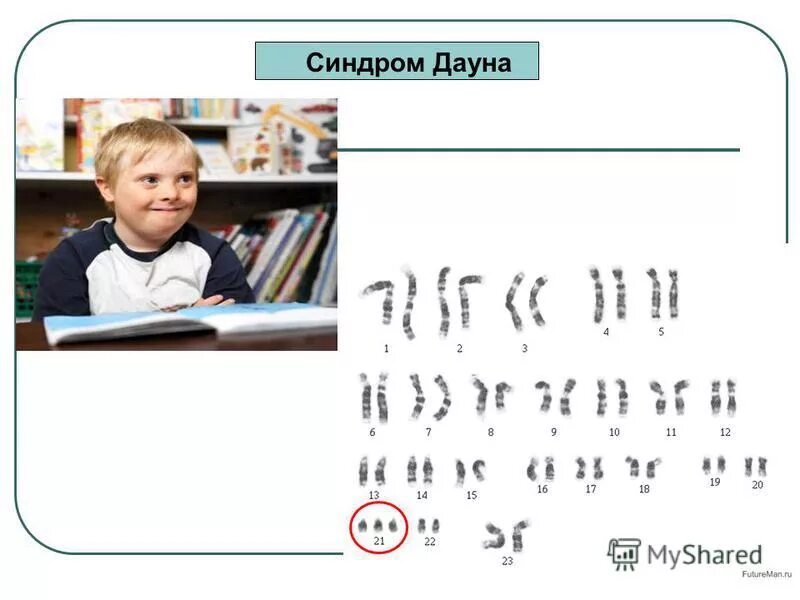 Синдром дауна генотип и фенотип. Синдром дауна генотип и фенотип. Болезнь дауна кариотип. Синдром дауна генотип и фенотип. Синдром трисомии хромосомы 8 кариотип.