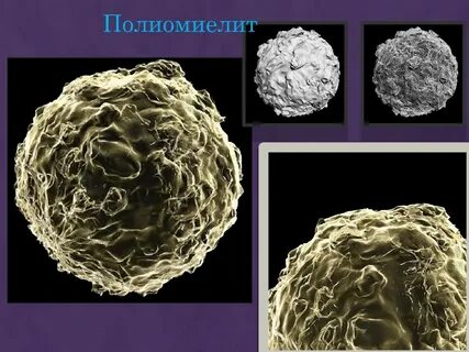 Полиомиелит симптомы и причины