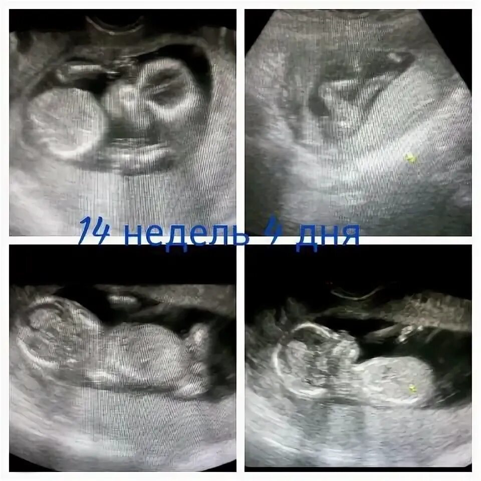 Крови 15 недель. УЗИ 15 недель беременности. Снимок УЗИ 15 недель беременности. УЗИ 15 недель беременности фото. УЗИ 14-15 недель беременности.