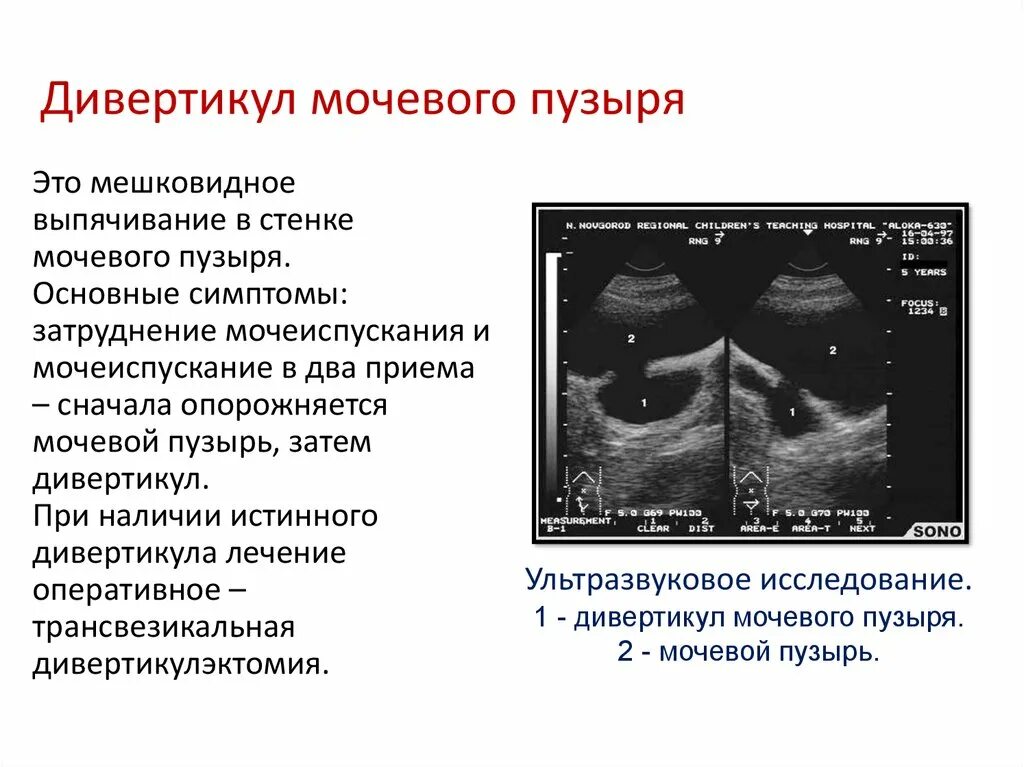 Удалили мочевой пузырь мужчине. Дивертикул мочевого пузыря рентген. Ложный дивертикул мочевого пузыря. Псевдодивертикулез стенок мочевого пузыря. Дивертикул стенки мочевого пузыря.