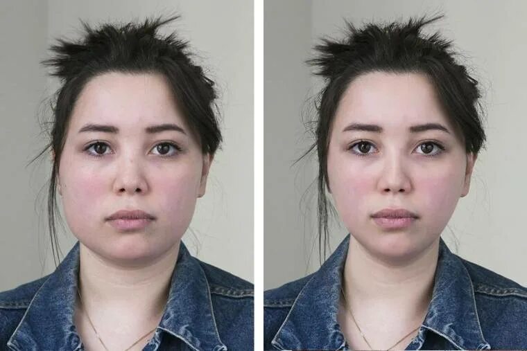 Пластические операции в корее. V-line пластика корея. Мандибулопластика корея. Пластические операции в корее. Пластическая операция на лицо.