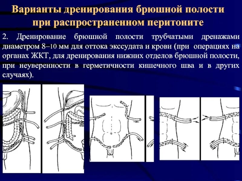 Дренирование брюшной полости. Редринирование брюшной поло. Закрытый метод дренирования брюшной полости при перитоните. Дренирование брюшной полости при перитоните. Операция по поводу перитонита