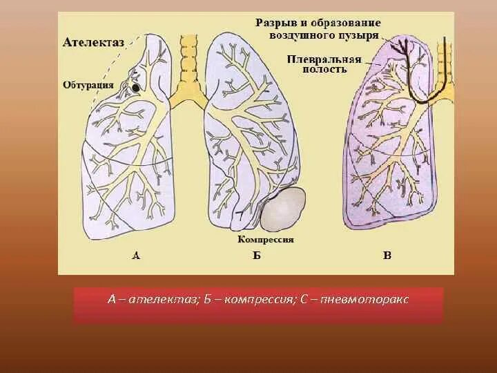 Ателектаз и пневмоторакс. Компрессионный ателектаз. Виды ателектаза. Компрессионный ателектаз легкого