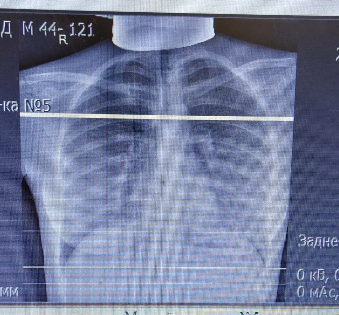 Делают рентген грудной клетки ребенку. Плевродиафрагмальные спайки рентген. Рентгенография грудной клетки ребенка в норме. Рентген грудной клетки норма. Детский рентген грудной клетки норма.