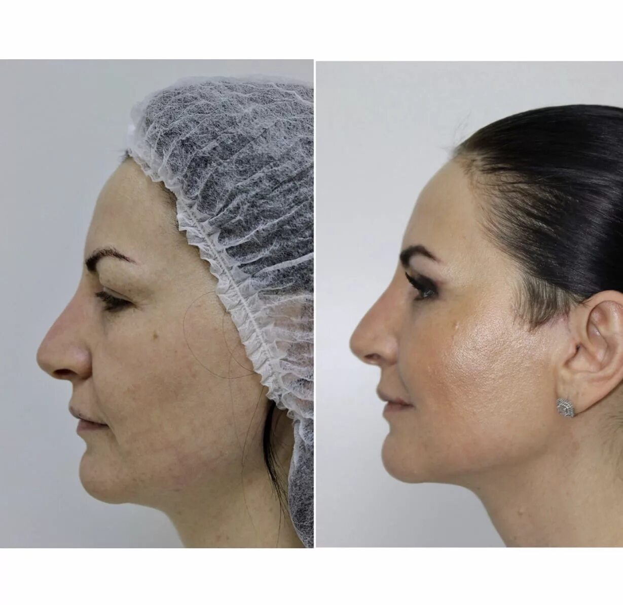 нити подтяжка аптос для подтяжки. смас блефаропластика лифтинг. тредлифтинг золотые нити. армирование лица золотыми нитями. нити аптос средняя треть лица.