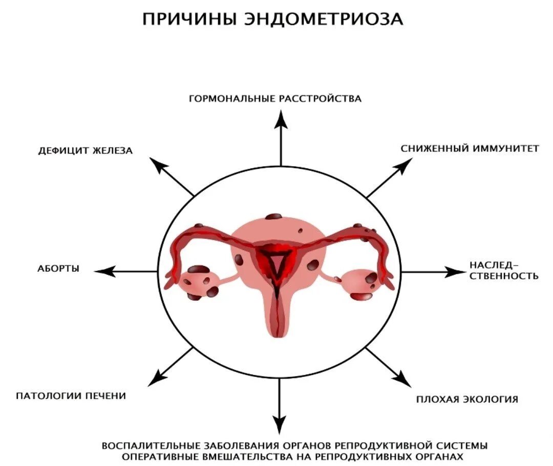 Как вылечить эндометриоз без гормонов. Как вылечить эндометриоз без гормонов