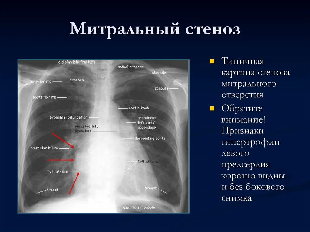 Стеноз митрального клапана рентген. Рентген при митральной недостаточности. Митральный стеноз рентген признаки. Стеноз митрального клапана рентген признаки.