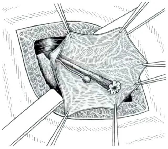 Колпачок для метки маток. Приспособление для метки пчелиных маток. Тейпирование при опущении матки. Сетка матки. Сетка матки.