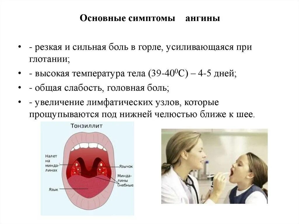 Появилась сильная боль в горле. Основные симптомы ангины. Ангина первичные симптомы.