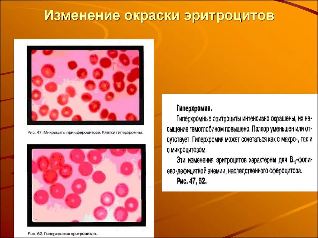 В12 анемия эритроциты гиперхромная. Мегаллобластная гиперхромная анемия. Изменение окраски эритроцитов при анемии. Гиперхромия макроцитоз. Клетки с гиперхромными ядрами