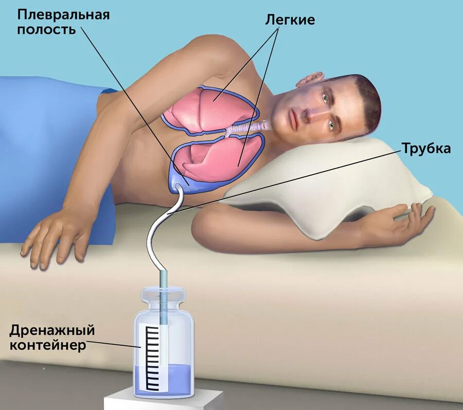 Почему при откачивании воздуха вода. Выкачивание жидкости из легких. Откачать из легкого жидкость. Откачивание плевральной жидкости. Выкачивание жидкости из плевральной полости.