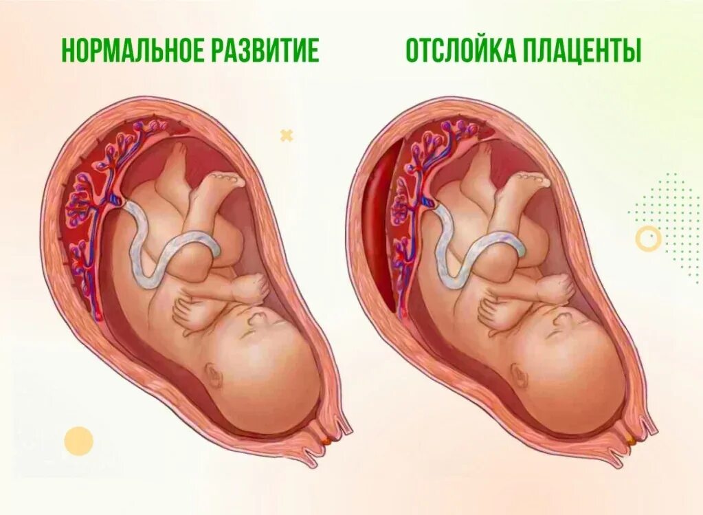 Во время этих двух недель. Отслойка плаценты в норме. Отслойка нормально расположенной плаценты.