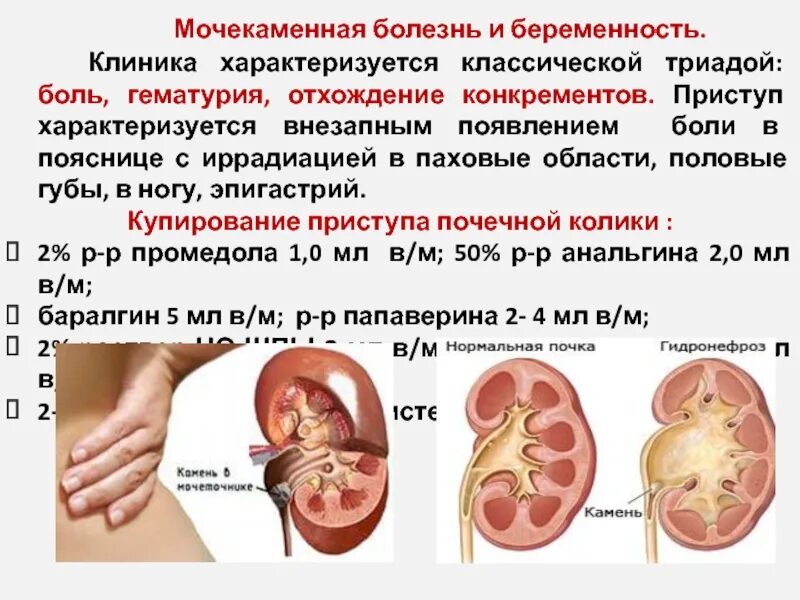 Заболевание при беременности. Мочекаменная болезнь макрогематурия. Камни в почках гематурия. Камни в почках при беременности 1 триместр. Мочекаменная болезнь причины возникновения.