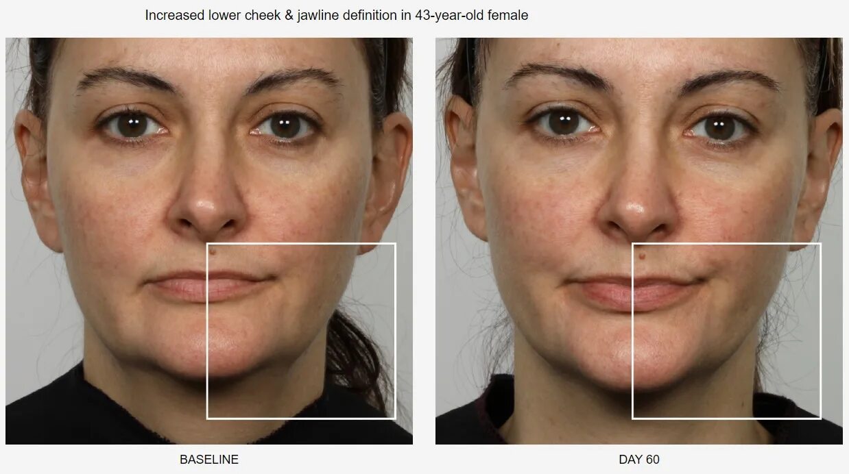 Микротоки лицо до и после фото отзывы. Nuface до после. микротоки для лица lj b gjckt. эффект от микротоков для лица. микротоковая терапия лица до и после.