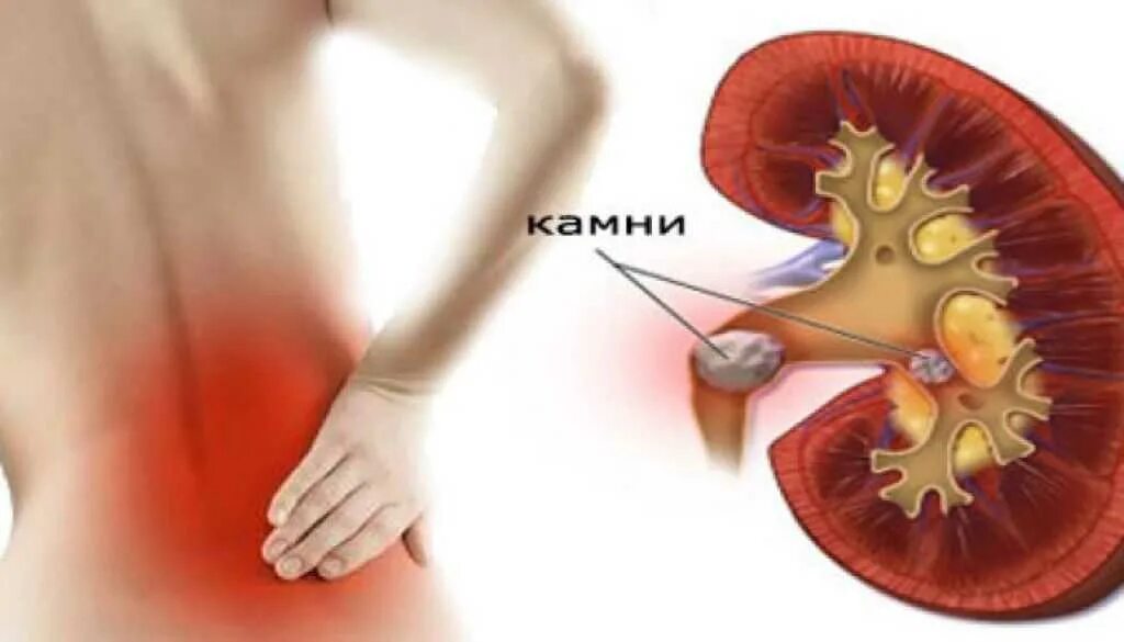 Мочекаменная болезнь почечная колика. Почечно-каменная болезнь почечная колика. Почечная колика при мочекаменной болезни. Мочекаменная болезнь камень лоханки левой почки. Ощущаются почки