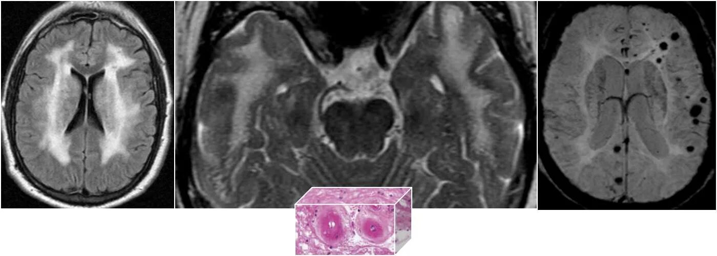 Диффузная атрофия головного мозга. ЦАДАСИЛ синдром мрт. Фокальная кортикальная дисплазия. Кортикальная дисплазия мрт. Фокальная корковая дисплазия головного мозга мрт.