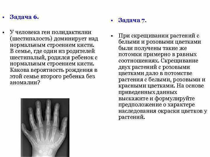 Полидактилия в генетических задачах. Полидактилия генное заболевание. Ген полидактилии задачи.