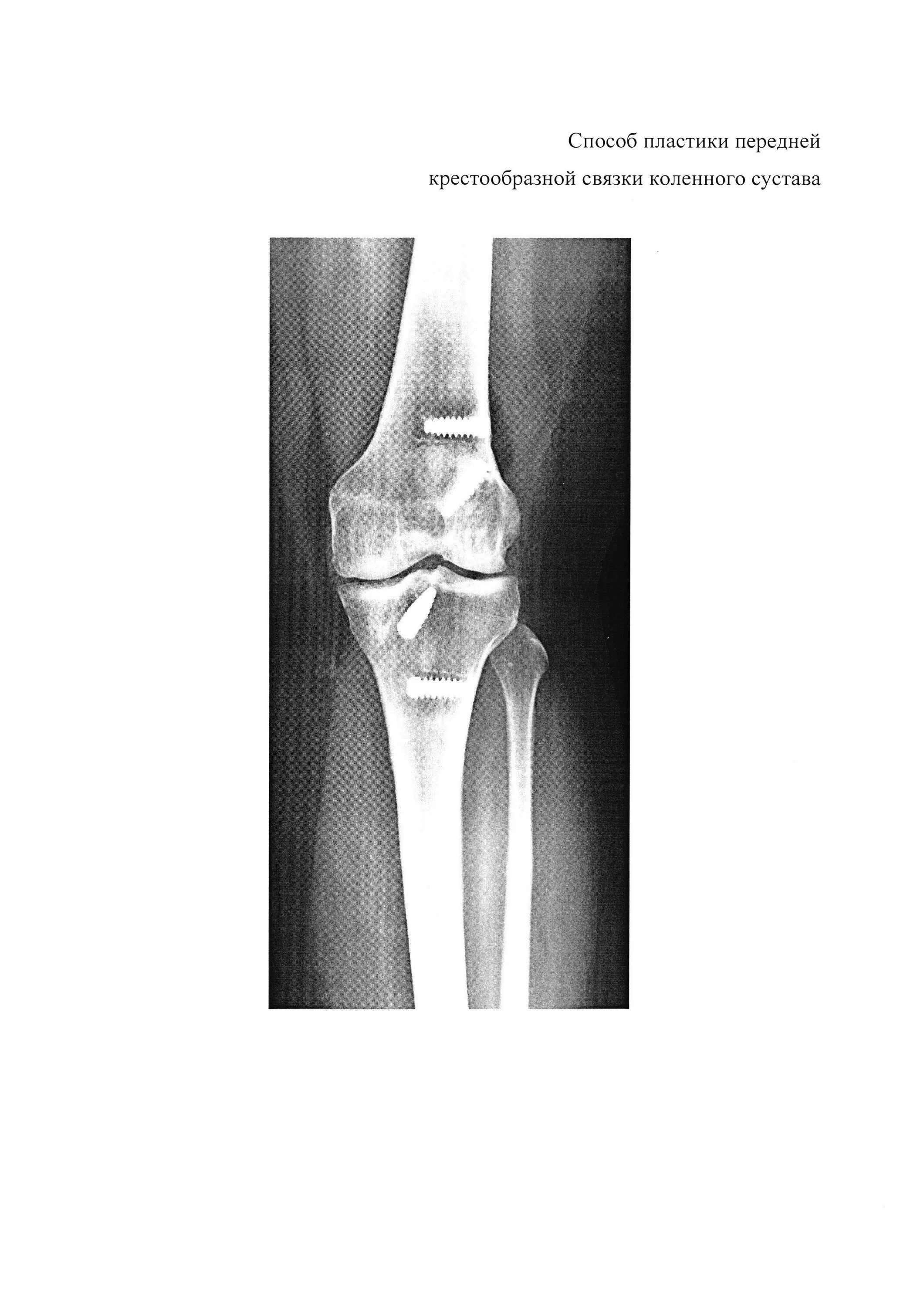Пластика крестообразной связки рентген. Операция на крестообразной связки рентген. Пластика передней крестообразной связки коленного сустава рентген. Пластика передней крестообразной связки (ПКС). Операция колено пкс