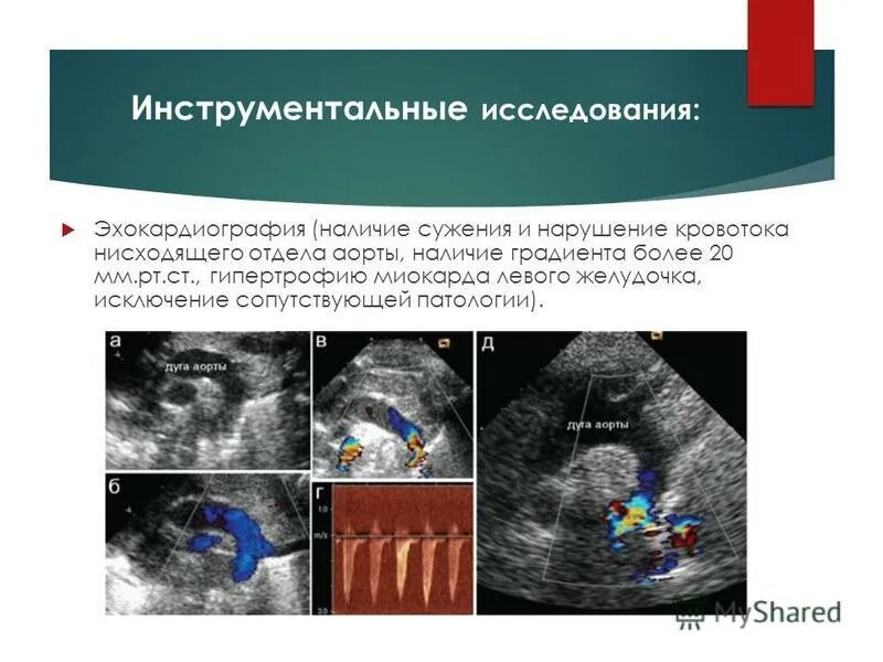 расслоение аорты на эхокг. расслаивающаяся аневризма аорты эхокг. расслаивающая аневризма аорты эхокг. двустворчатый аортальный клапан эхокардиография. эхокардиография аорты.