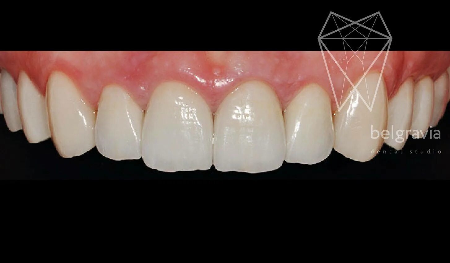 металлокерамическая коронка. коронка или зуб из dsc-циркониевой керамики а 16. несъемный металлокерамический протез. металлокерамика какой металл. керамика металл коронка.