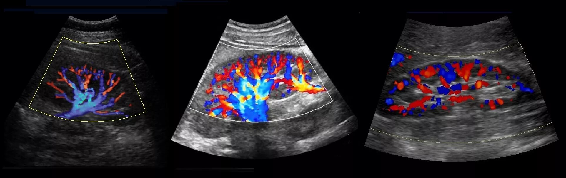 Доплер почек. Допплерография сосудов почек УЗИ. УЗИ сосудов почки допплер. УЗИ С доплер почек допплерографией сосудов почек. Почечные артерии УЗИ ЦДК.