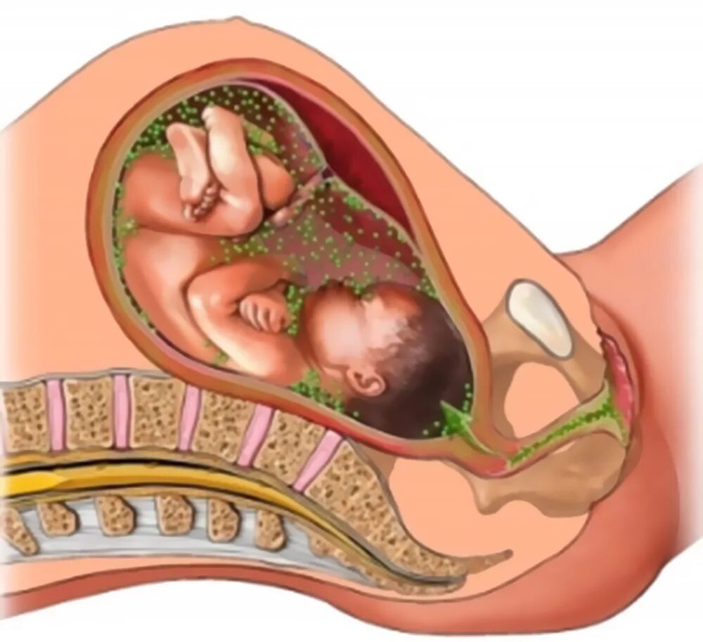 Амниотомия (вскрытие плодного пузыря). Внутриутробная инфекция в период беременности. Внутриутробная инфекция хламидиоз. Трансплацентарный путь передачи. Сколько роды после прокола пузыря