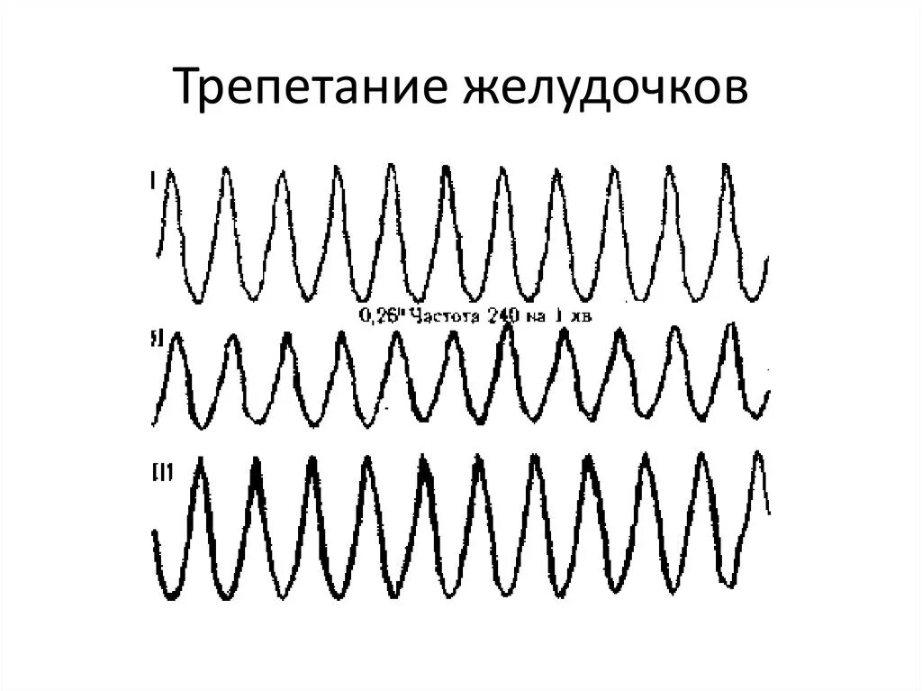 Трепетание желудочков на ЭКГ. Фибрилляция и трепетание на ЭКГ. Мелковолновая фибрилляция желудочков ЭКГ. Трепетание и мерцание желудочков на ЭКГ.