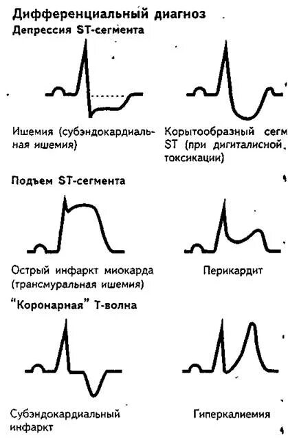 Сегмент st при инфаркте. Экг инфаркт миокарда с подъемом st. стадия ишемии инфаркта миокарда на экг. острая ишемия миокарда на экг. st при инфаркте миокарда на экг.