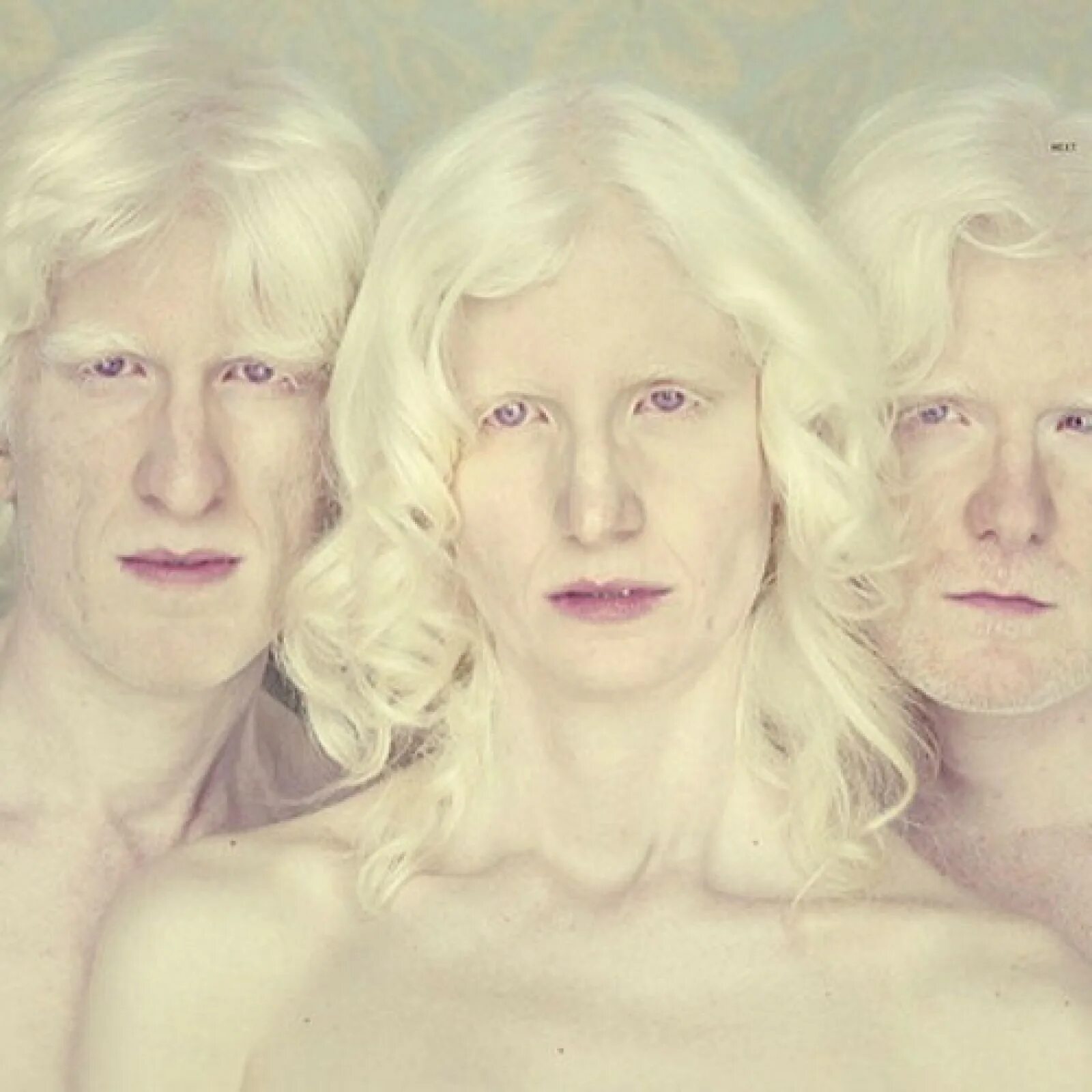 Страдающий альбинизмом. Глазокожный альбинизм Тип 3. Альбиносы люди.