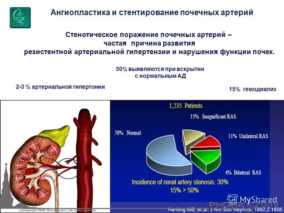 Стентирование почечной артерии. Тромбоз почечной артерии кт. Баллонная ангиопластика почечной артерии. Противопоказания к стентированию почечных артерий. Стеноз почечной артерии кт.