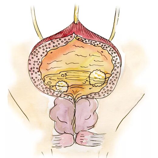 Камень мочевого пузыря и аденома. Аденома предстательной железы и камни. Аденома простаты камень мочевого пузыря. Мочевой пузырь и простата. Неприятно в мочевом пузыре