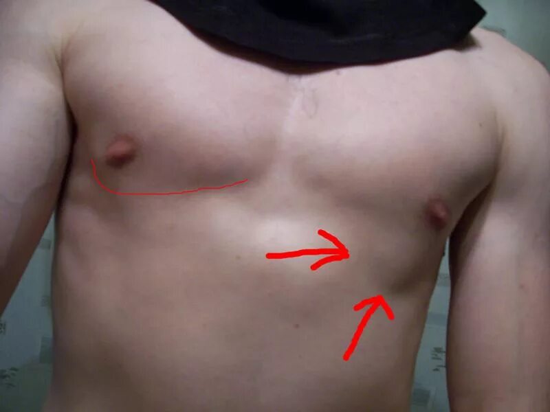 Condition Specific Radiology: Pneumonia - Stepwards