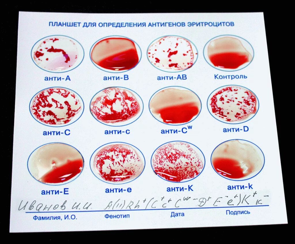 Группа крови цоликлонами и резус-фактор. Чашка Петри для определения группы крови. Определение группы крови и резус. Планшет для определения группы крови и резус фактора.