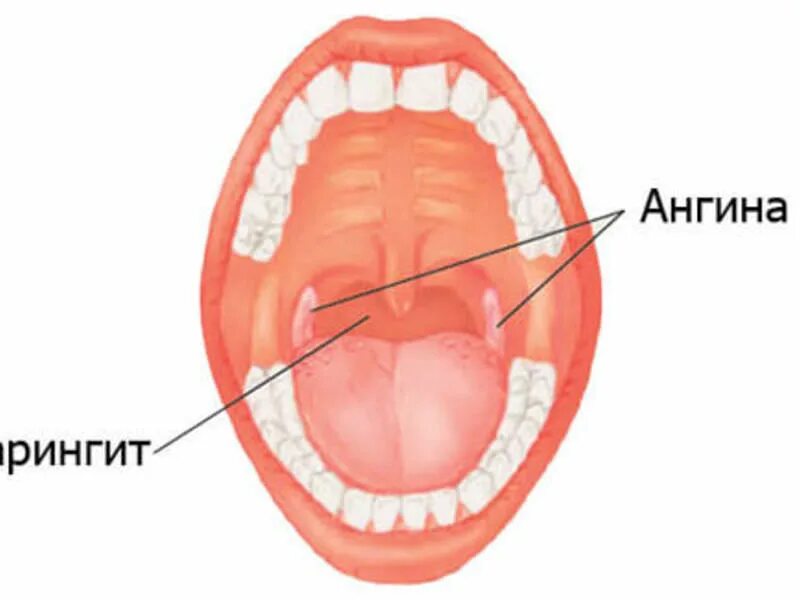 Во рту температура без. Фарингит зев гиперемирован. Тонзиллит фарингит ангина отличия. Миндалины ротовой полости. Тонзиллит фарингит ларингит различия.