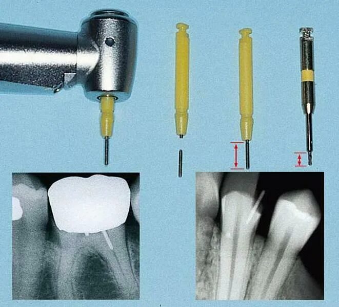 Пины в стоматологии. Анкерный парапульпарный стекловолоконный штифт. Анкерный титановый стекловолоконный штифт. Анкерные штифтовые вкладки. Парапульпарные штифты рентген.